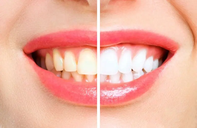 Professional teeth whitening treatment at Recreate Smiles dental clinic Joondalup