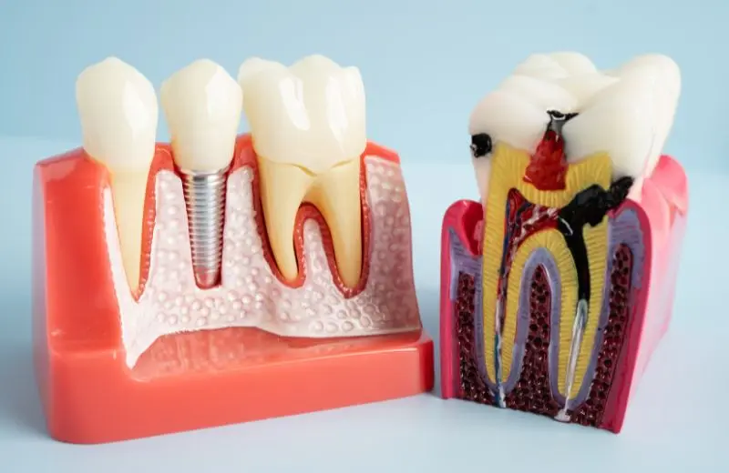 Root canal treatment being performed at Recreate Smiles dental clinic Joondalup