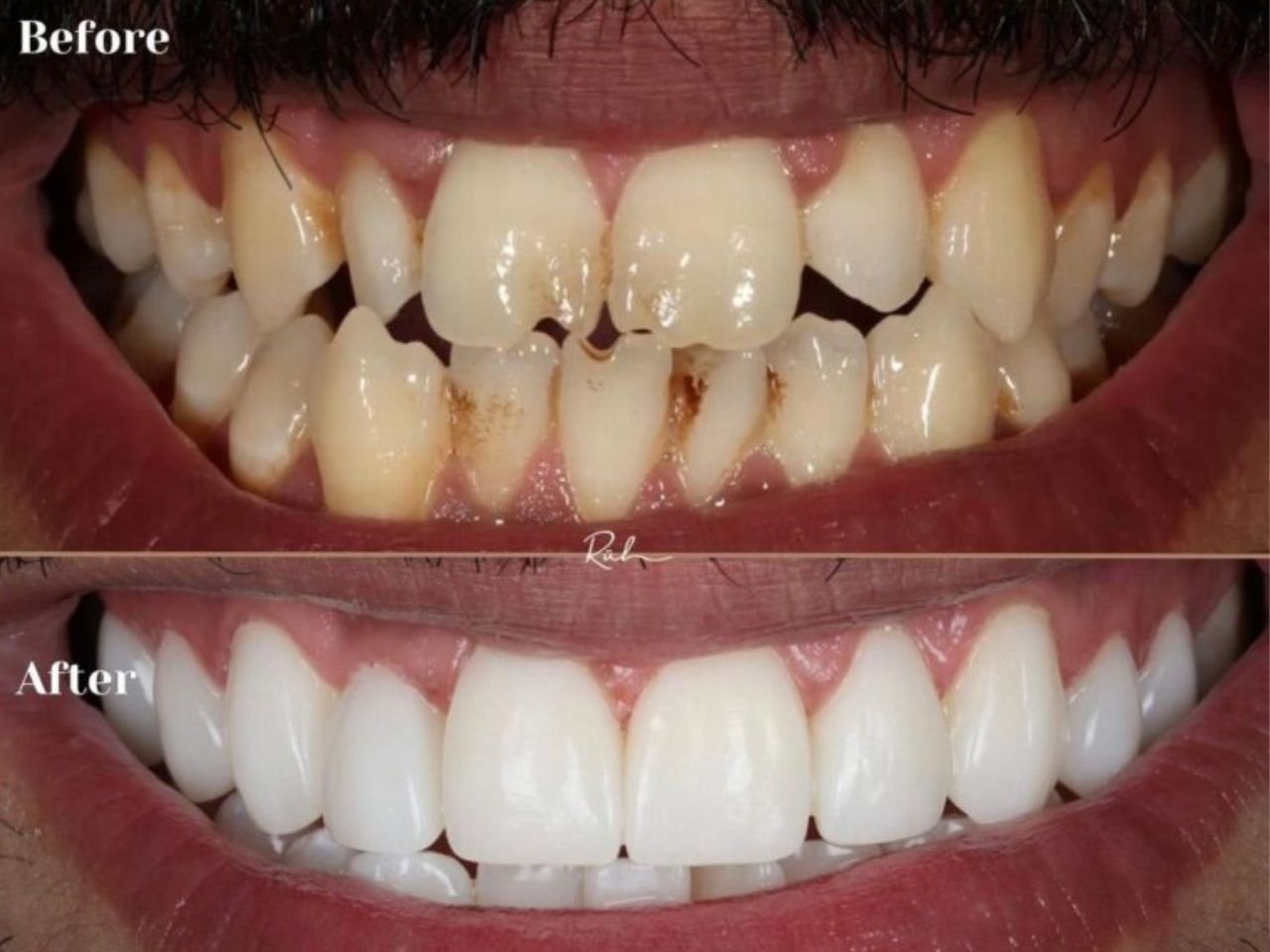 Composite veneers treatment