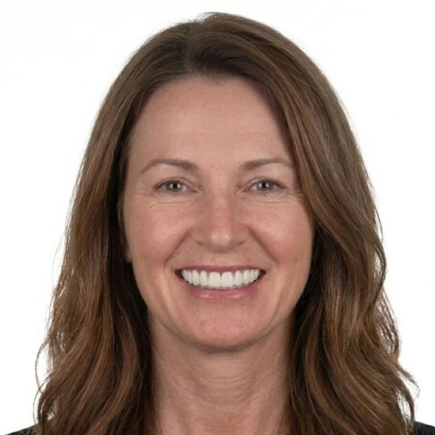 Full arch All-on-X implants, Recreate Smiles Joondalup