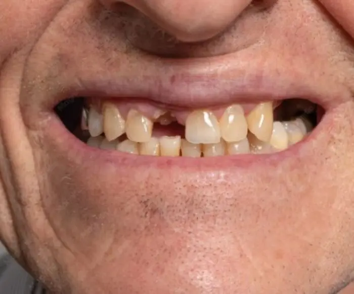 Single implant case photo, Recreate Smiles Joondalup